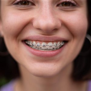 כמה עולה לעשות גשר בשיניים